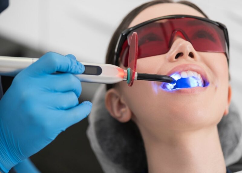 Чим професійні методи відбілювання зубів кращі за домашні засоби?