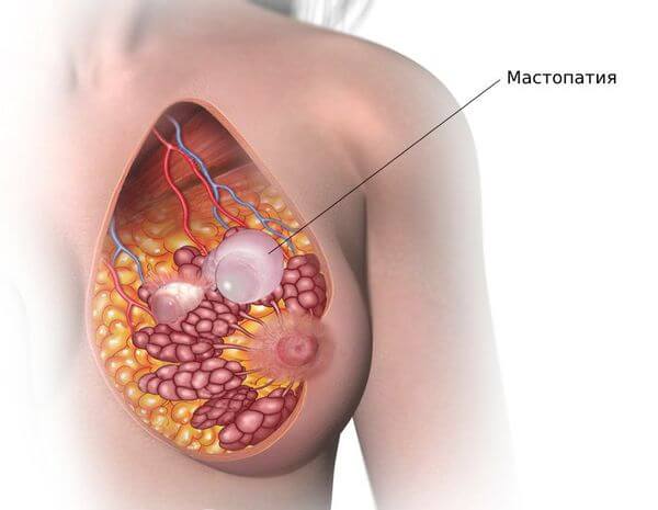 Мастопатія - Як позбутися мастопатії?