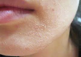 Сухість шкіри - Як лікувати сухість шкіри навколо рота?