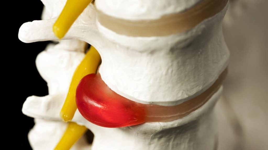 Звідки береться грижа хребта і що з нею робити