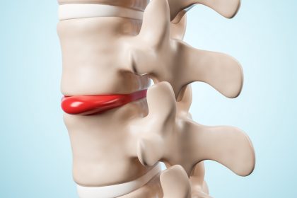 Межпозвоночная грыжа: когда нужна нейрохирургия?