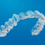 Виправлення прикусу та вирівнювання зубів: ефективно та зручно з елайнерами Інвізілайн